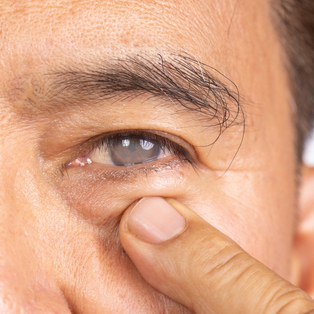 Cirurgia de Glaucoma